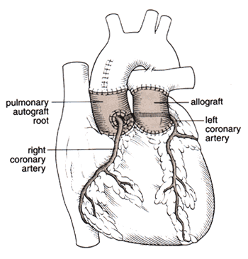 The Ross Procedure