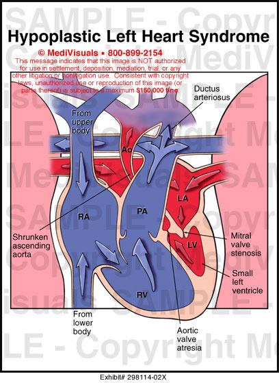 Shone's Syndrome